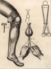 Хирургия. Приспособление для фиксации коленного сустава (Ивердонская энциклопедия. Том III. Швейцария, 1776 год)
