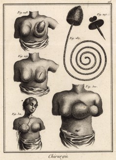 Хирургия. Операции на груди (Ивердонская энциклопедия. Том III. Швейцария, 1776 год)