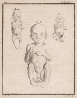 Человеческий эмбрион (лист VI иллюстраций к третьему тому знаменитой "Естественной истории" графа де Бюффона, изданному в Париже в 1750 году)